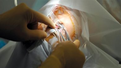 صورة شاب يخضع لعملية زراعة قرنية والسبب “فرك” عينيه… هذا ما حدث
