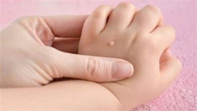 صورة ما أسباب وأعراض الثآليل عند الأطفال؟