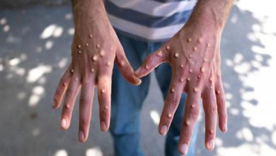 صورة دولة تسجل 5 إصابات بـ جدري القرود.. فما هي ؟