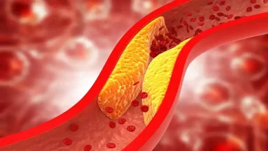 صورة 4 أسباب خفية وراء ارتفاع الكوليسترول