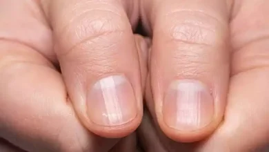 صورة علامات خفية في الأظافر قد تكشف إصابتك بمرض قاتل
