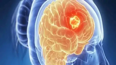 صورة علامات لا يجب تجاهلها.. أعراض تكشف إصابتك بسرطان الدماغ مبكرًا