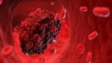 صورة علامات مبكرة وتحذيرات من جلطات الدم.. تعرف عليها قبل أن تُهدد صحتك