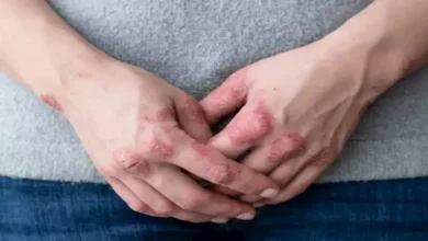 صورة 4 أعراض تحذيرية تكشف الإصابة بالإكزيما