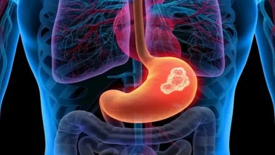 صورة 5 علامات صامتة لسرطان المعدة.. لا تتجاهلها