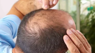 صورة دراسة تكشف علاقة الصلع عند الرجال بالمشروبات السكرية