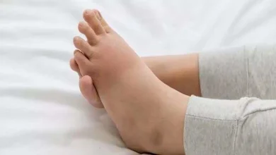 صورة تورم القدم علامة على أمراض خطيرة.. وما علاقته بجلطات الدم؟