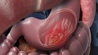 صورة أعراض تشير إلى الإصابة بسرطان القولون
