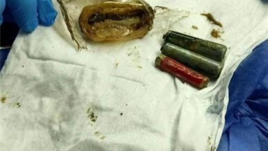 صورة استخراج 3 بطاريات عالقة في معدة مريض لأكثر من عام ونصف  أخبار السعودية