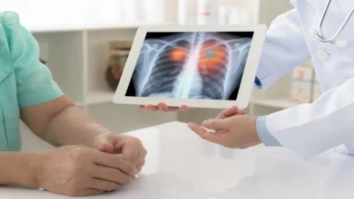 صورة تظهر على الساقين.. علامة تكشف الإصابة بسرطان الرئة