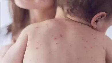 صورة لأول مرة منذ 35 عامًا.. تفشي مرض الحصبة بولاية أمريكية