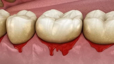 صورة “يا دكتور أسناني تنزف عند التنظيف”.. طبيب يكشف الأسباب والمضاعفات