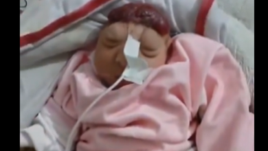 صورة حالة صادمة بغزة.. ولادة طفلة “بلا دماغ” ومطالب بالتحقيق في أسلحة “إسرائيل” (فيديو)