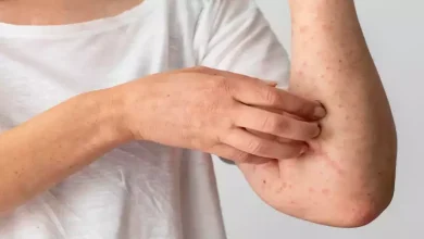صورة الإكزيما.. إليك الأعراض والأسباب وطرق العلاج