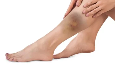 صورة احذر.. الكدمات الغامضة في جسمك علامة على مشكلة صحية خطيرة