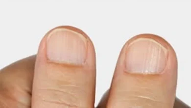 صورة علامة على الأظافر تكشف إصابة امرأة بهذا النوع من السرطان