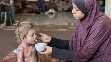 صورة المرض ينهش جسد الطفلة نور على وقع القتل والمجاعة في غزة