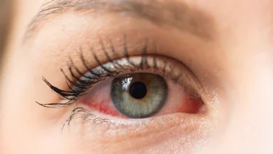 صورة 4 أعراض مفاجئة تكشف إصابتك بحساسية العين.. انتبه قبل أن تتفاقم