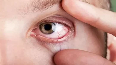 صورة تظهر في العين.. أعراض تكشف ارتفاع نسبة الكوليسترول بشكل خطير