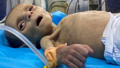 صورة وفاة طفل بغزة بسبب سوء التغذية الحاد