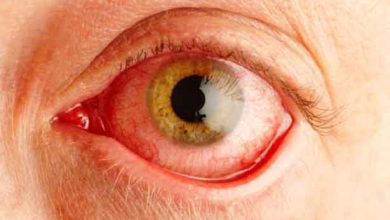 صورة 5 مشكلات صحية خطيرة يشير إليها احمرار العين