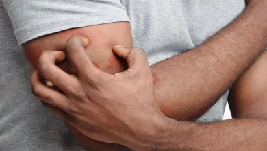 صورة احذر.. الحكة بعد الاستحمام قد تشير إلى أمراض خطيرة