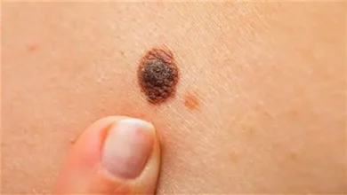 صورة أعراض خطيرة.. إصابة فتاة بالسرطان بعد معاناتها من ألم في هذه المنطقة