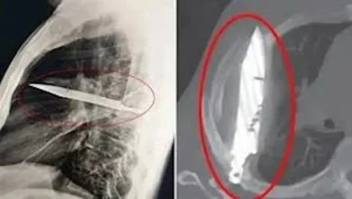 صورة رجل يعيش 8 سنوات بشفرة سكين في صدره دون أن يدري “صور”