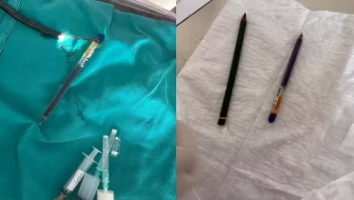 صورة لن تتوقع.. هذا ما استخرجه أطباء من معدة شابة تركية (صور)