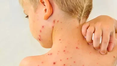 صورة بعد تسجيل إصابات بين طلاب المنوفية.. ما هو الجدرى المائى وأعراضه وطرق
