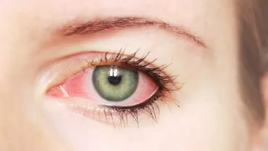 صورة 5 أعراض تدل على التهابات العين.. احذرها