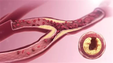 صورة 5 علامات تكشف انسداد شرايين القلب.. احذرها
