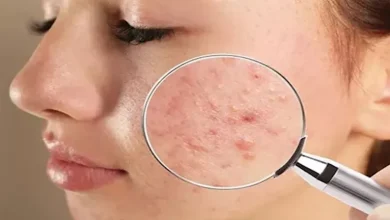 صورة أفضل روتين لعلاج حب الشباب.. احرص عليه