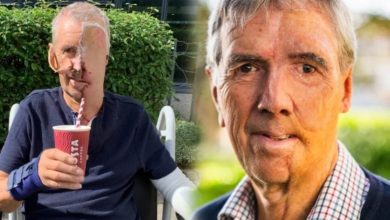 صورة معجزة «NHS»: أول وجه مطبوع ثلاثي الأبعاد لرجل فقد ملامحه في حادثة!  أخبار السعودية