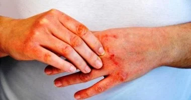 صورة ليس فقط العوامل الوراثية.. ما سبب وعلامات الإصابة بالصدفية