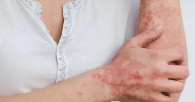 صورة 6 خرافات طبية حول الصدفية في اليوم العالمي للصدفية.. صحح معلوماتك