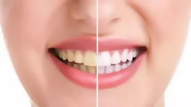 صورة 5 عوامل تسبب اصفرار الأسنان.. أبرزها الشاي والقهوة
