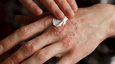 صورة التهاب الجلد الدهني.. إليك أسبابه وطرق الوقاية