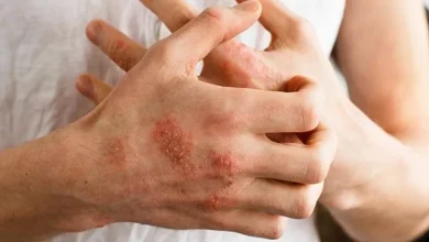 صورة كيف تعرف أنك تعاني من حساسية جلدية؟ 5 علامات واضحة