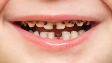 صورة تسوس أسنان الأطفال اللبنية.. إليك الأعراض والمخاطر