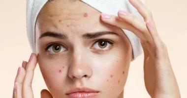 صورة طرق طبيعية بسيطة لعلاج حب الشباب.. أبرزها الليمون والعسل