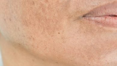 صورة دليل علاج تصبغات الوجه: خطوات للحصول على بشرة متوهجة وموحدة اللون