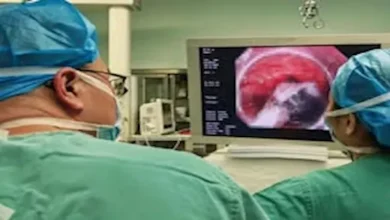 صورة رجل صيني عاش 30 عامًا بولاعة في معدته دون أن يعلم.. ما القصة؟