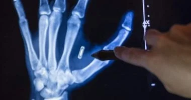 صورة رجل يفقد السيطرة على شريحة RFID المزروعة في يده وينسى كلمة مرورها