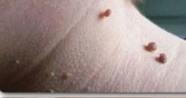 صورة أسباب ظهور الزوائد الجلدية وطرق علاجها