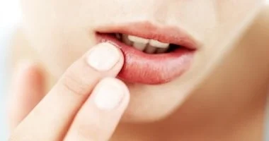صورة طرق لعلاج تشقق الشفاه في 3 أيام لتكون ناعمة ورطبة